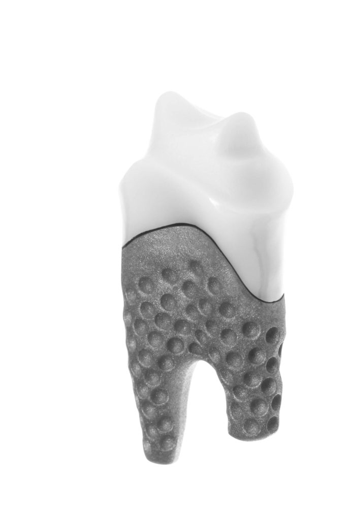 Implant wydrukowany w technologii 3D (zdjęcie: Natural Dental Implants 3D).