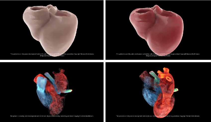 Cyfrowy bliźniak serca. Zbudowany w oparciu o obrazy MR i pomiary EKG, cyfrowy model symuluje procesy fizjologiczne narządu pacjenta, pozwalając wizualizować reakcję pacjenta na leczenie i planować leczenie (zdjęcie:  Siemens Healthineers)