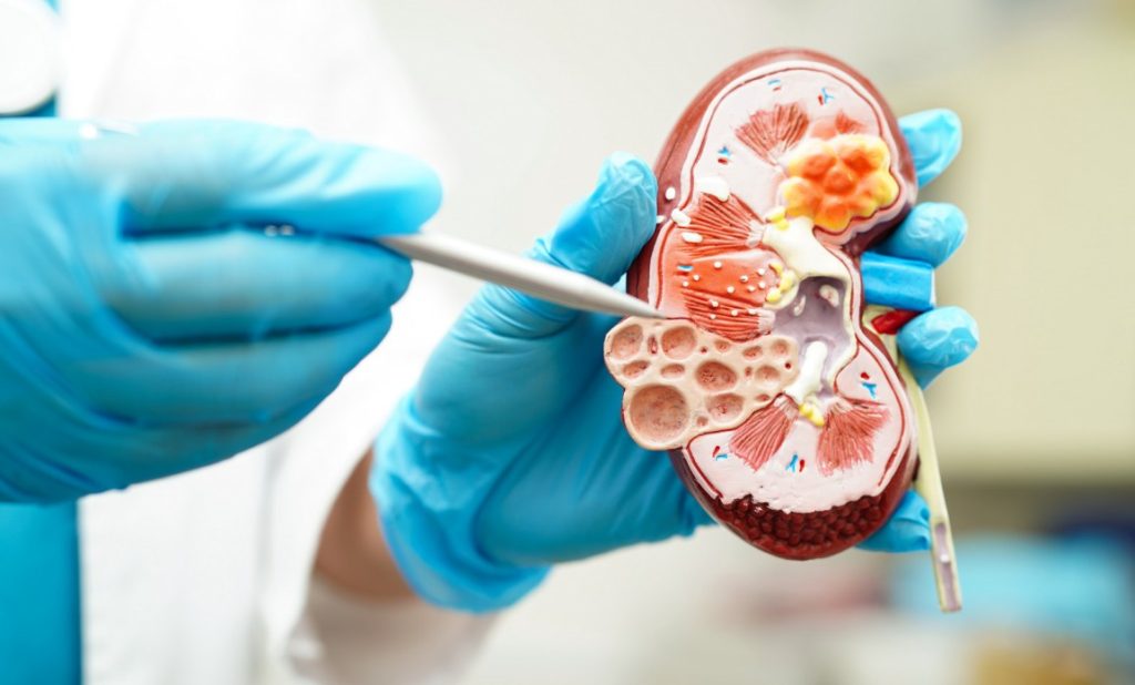 Ale gdy kamienie nerkowe są większe i blokują przepływ moczu, dotąd trzeba je było usuwać chirurgicznie