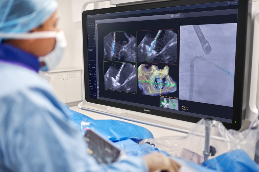 DeviceGuide pomaga w dokładnym manewrowaniu cewnikiem i precyzyjnym osadzeniu impantu we wnętrzu bijącego serca