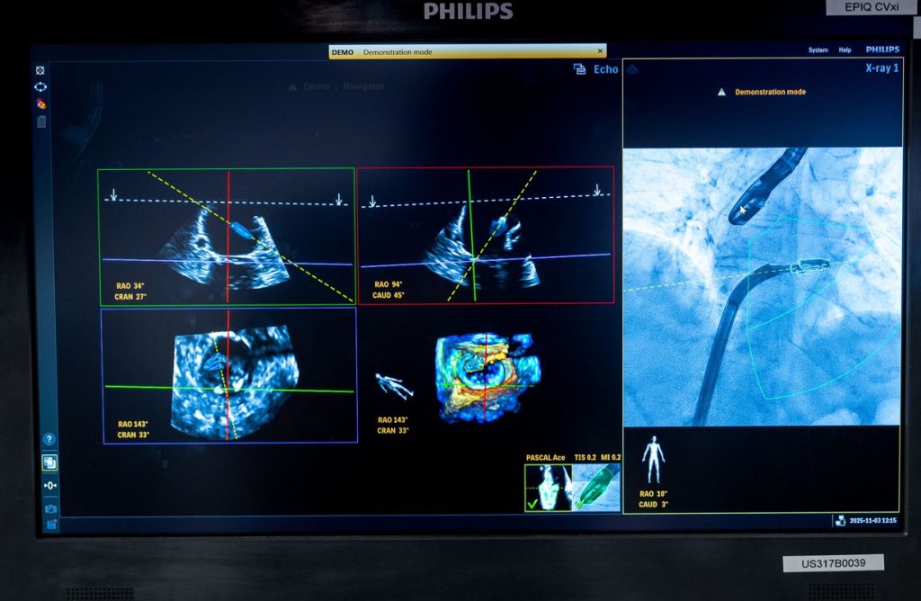 AI pomaga kardiochirurgowi nawigację podczas zabiegu TEER, analizując obrazy w czasie rzeczywistym  