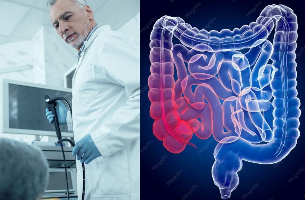  Systemy AI mogą ograniczać ryzyko przeoczenia zmian, podnosząc jakość kolonoskopii